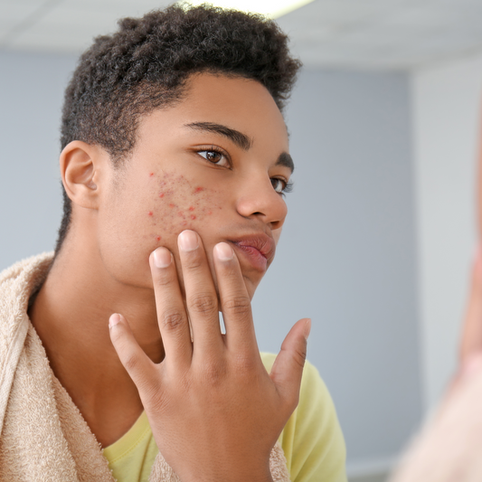 Acne Vulgaris